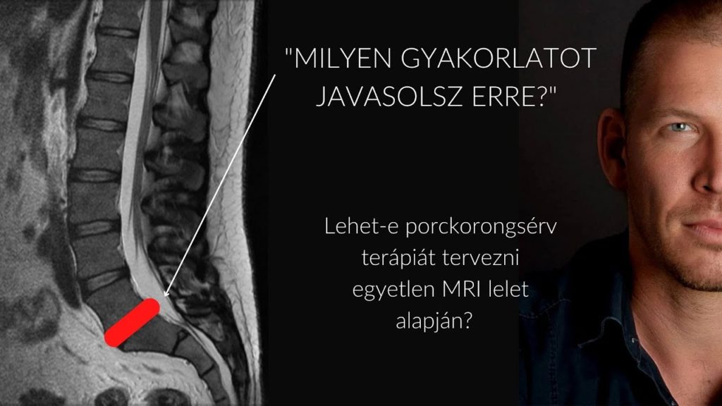MRI lelet alapján gerinctorna gyakorlatok?